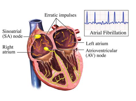 so it can dilate blood vessels with causes the heart rate to go up and trigger a fib. . Can a tens unit cause atrial fibrillation